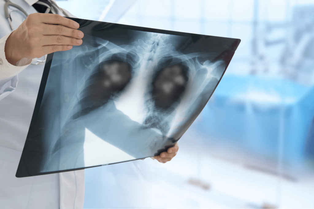 Pneumonia | Best Pneumonia Doctor In Mumbai