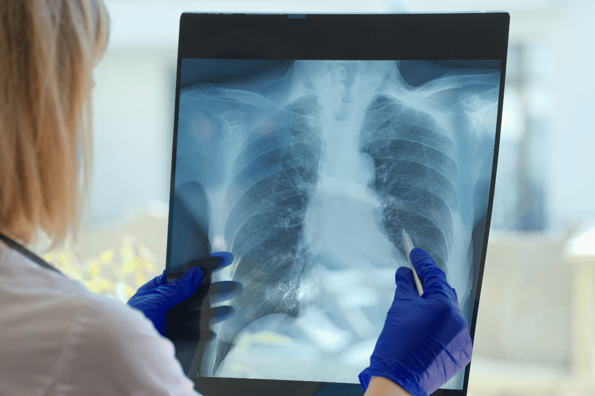 Tuberculosis​ | Best Tuberculosis Doctor in Mumabi